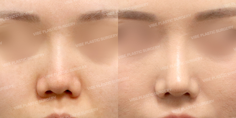 #코재수술 #기증늑 #짧은코 #비순각교정