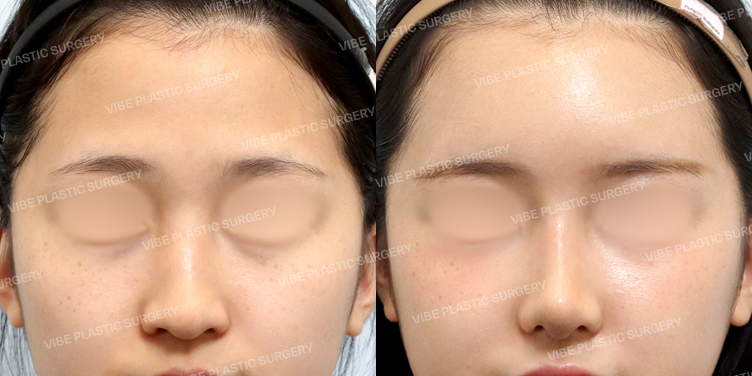 #풀페이스지방이식(이마,관자,눈밑) #콧대 #코끝 #자가늑 #복코 #긴코 #매부리 #절골 #비순각교정