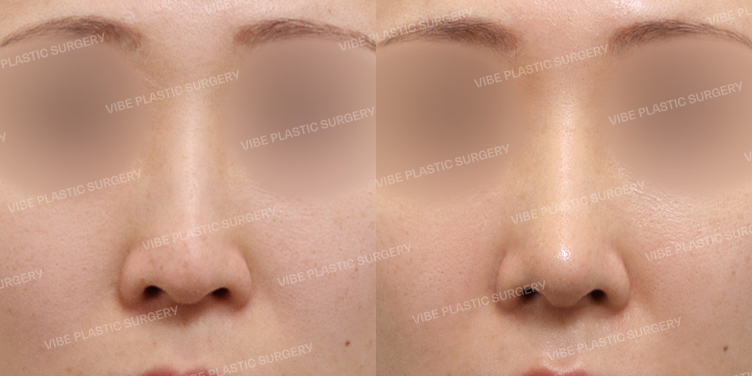 #무보형물코성형 #코끝 #비중격 #기증늑 #긴코교정 #매부리