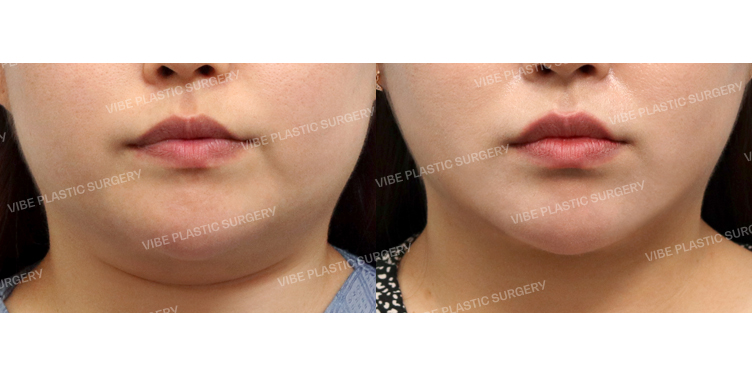 #초음파지방흡입 #침샘보톡스