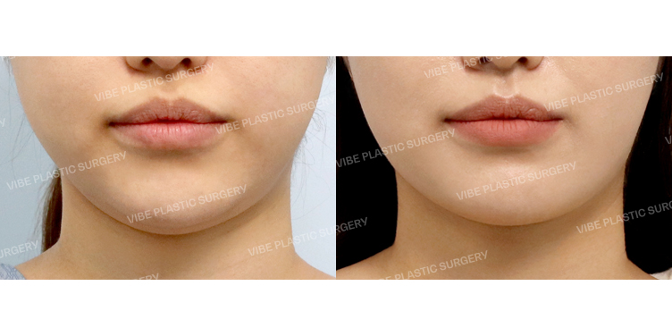 #초음파지방흡입(이중턱,턱라인) #심부볼지방제거