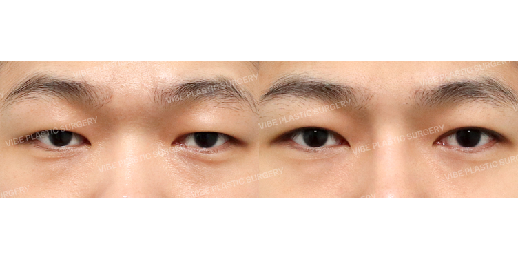 #부분절개눈매교정