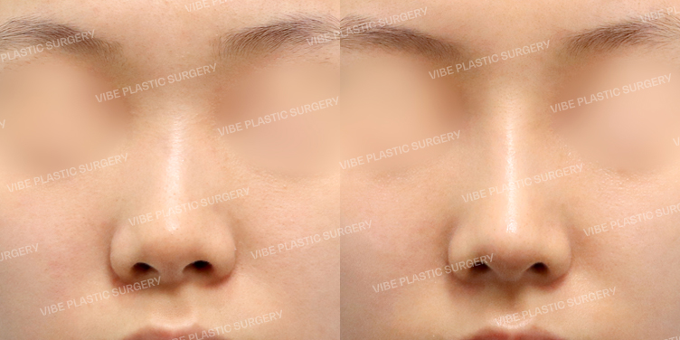 #콧대 #코끝 #기증늑 #절골 #복코 #짧은코