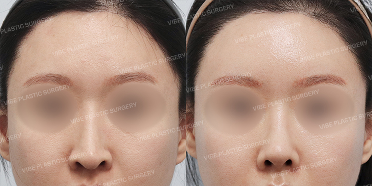 #지방이식(이마,관자) #코재수술 #코끝 #자가늑 #긴코 #용코