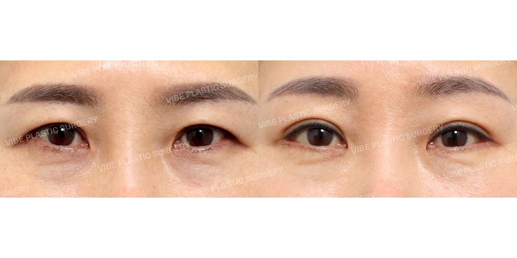 #비절개눈매교정(재수술) #뒤트임 #밑트임