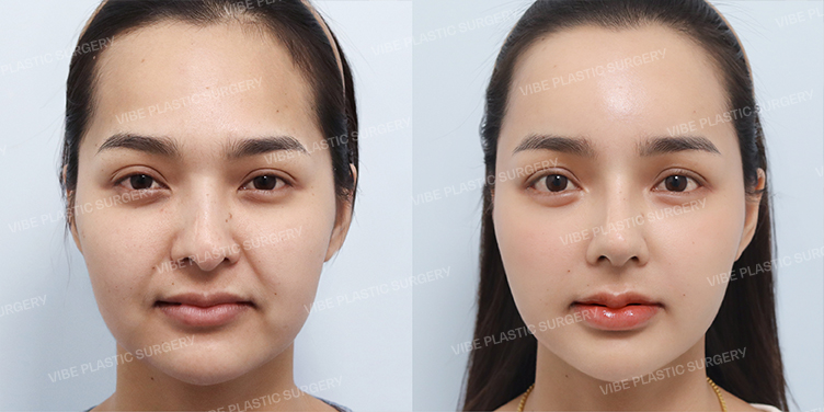 #복코 #휜코 #비주교정 #자가늑 #비절개눈매교정 #뒤밑트임 #얼굴지방흡입 #심부볼지방제거 #풀페이스지방이식