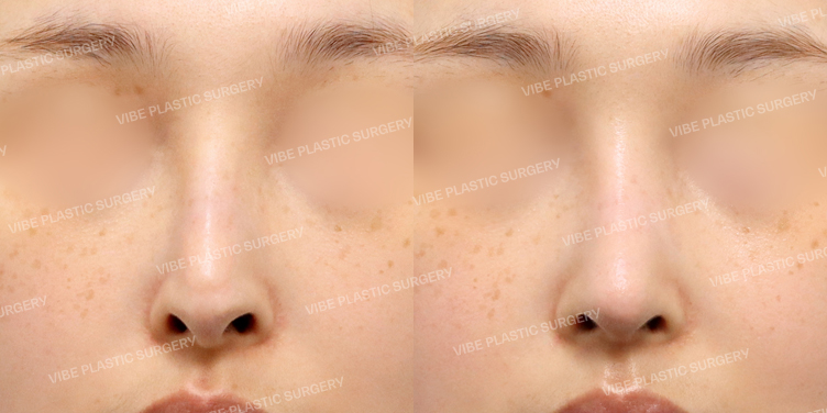 #코재수술 #기증늑 #휜코 #화살코