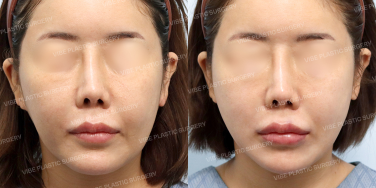 #실리프팅 #동안주사 #레디어스 #관자필러