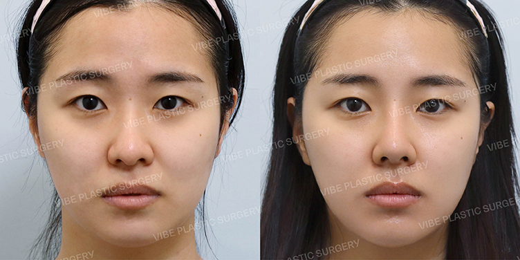 #코끝 #기능코 #비중격 #매부리 #긴코 #복코