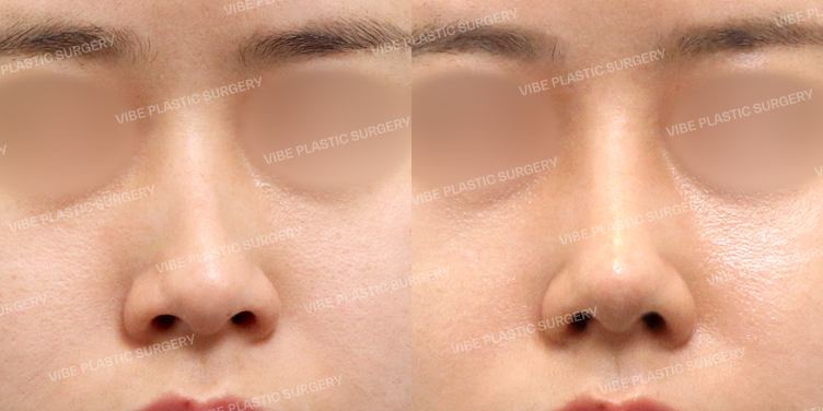 #무보형물 #매부리코 #이물질제거 #휜코 #비순각교정 #비중격