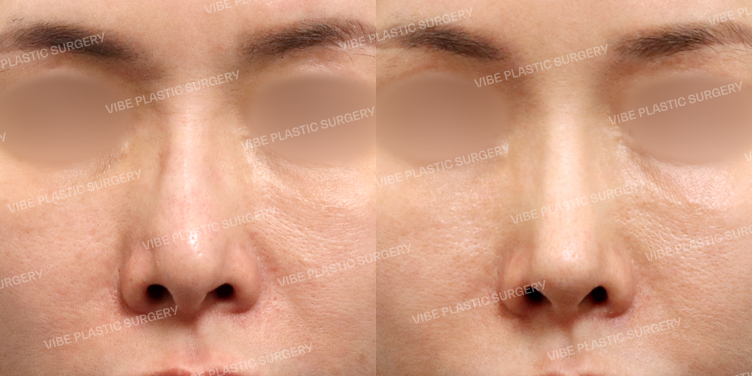 #코재수술 #무보형물 #비중격 #기증늑 #복코 #비주 #매부리코