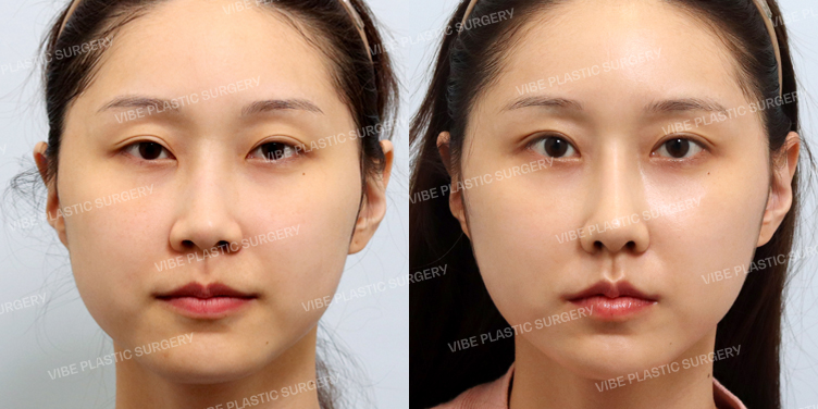 #절개눈매교정(재수술) #눈두덩이지방재배치 #콧대 #코끝 #복코 #긴코 #매부리 #비순각교정