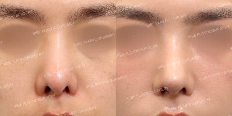 #코재수술 #무보형물 #복코 #비공교정 #기증늑