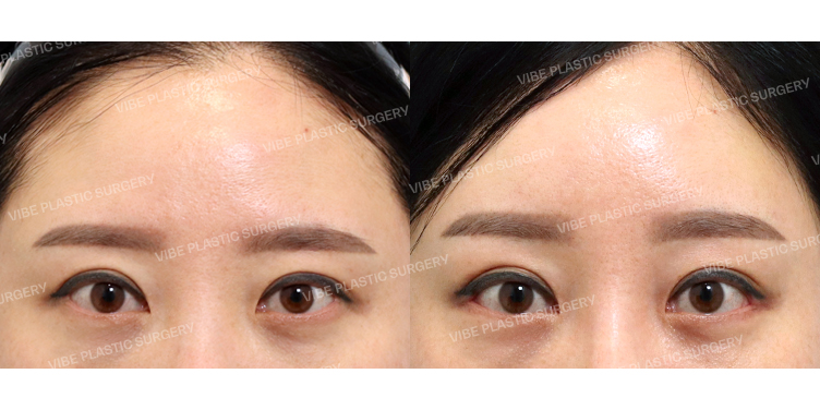 #내시경이마거상 #뒤밑트임