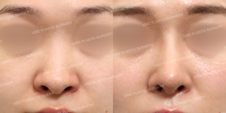 #콧대 #코끝 #이물질제거 #긴코 #비주교정 #비절개콧볼축소 #비중격