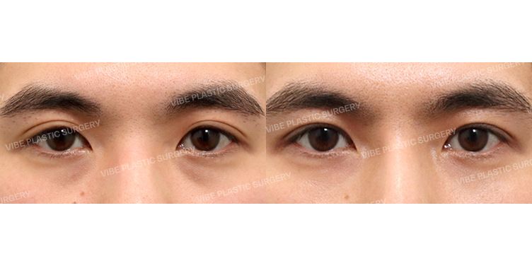 #비절개눈매교정