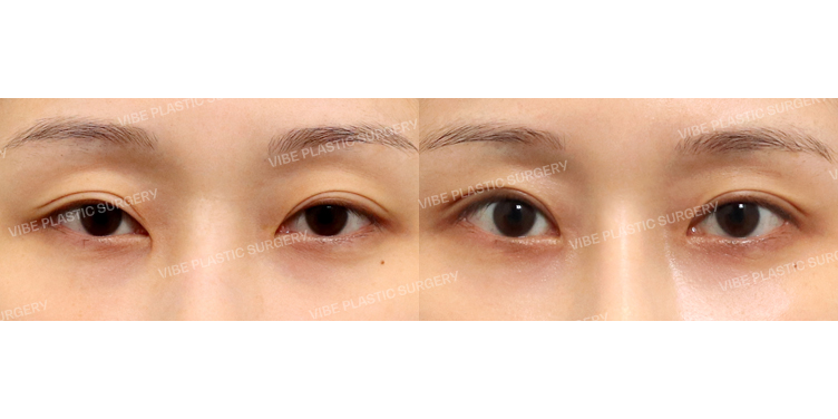 #절개눈매교정(재수술) #눈두덩이지방재배치