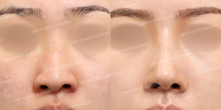 #콧대 #코끝 #절골 #휜코 #긴코 #이물질제거 #비중격 #기증늑