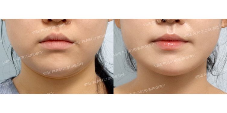 #초음파지방흡입(이중턱,턱라인)