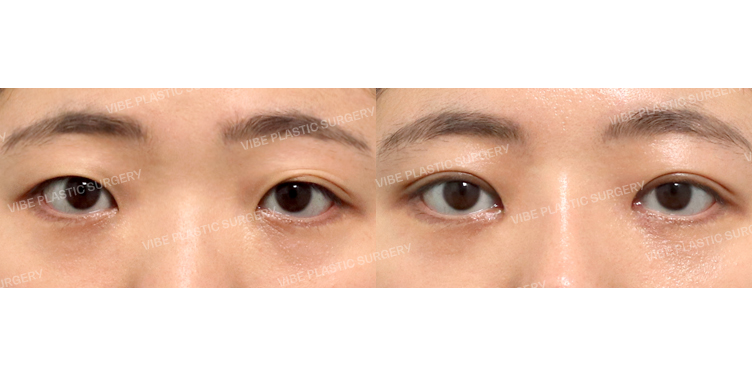 #부분절개눈매교정 #윗트임 #앞트임