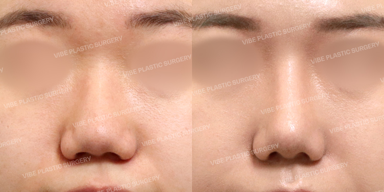 #콧대 #코끝 #복코 #비순각교정 #이물질제거 #비중격