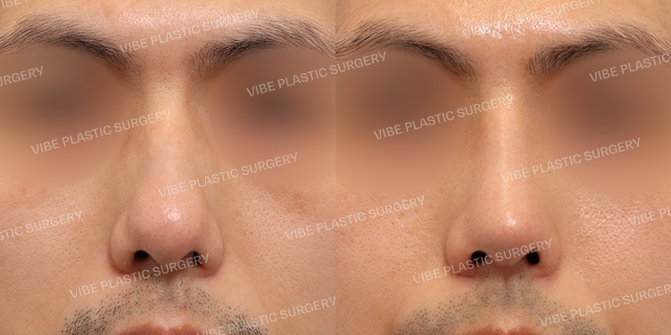 #무보형물 #매부리코 #복코