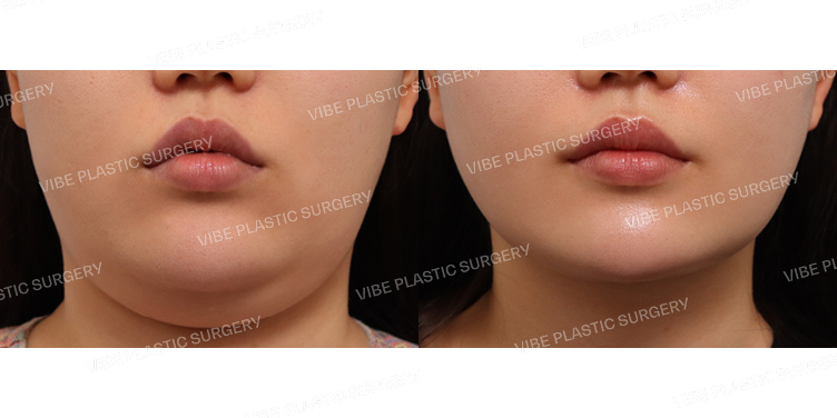 #초음파지방흡입(이중턱,턱라인)