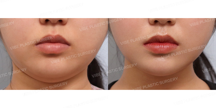 #초음파지방흡입(이중턱,턱라인) #심부볼지방제거 #침샘보톡스