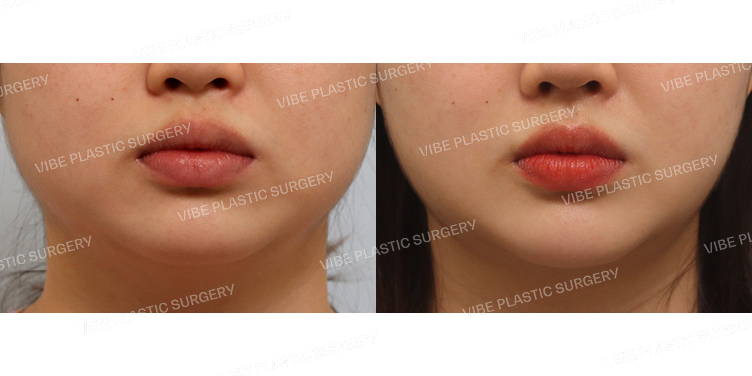 #초음파지방흡입(이중턱&턱라인) #심부볼지방제거