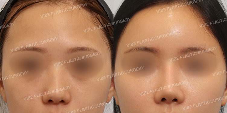 #이마지방이식 #낮은코 #매부리코 #복코