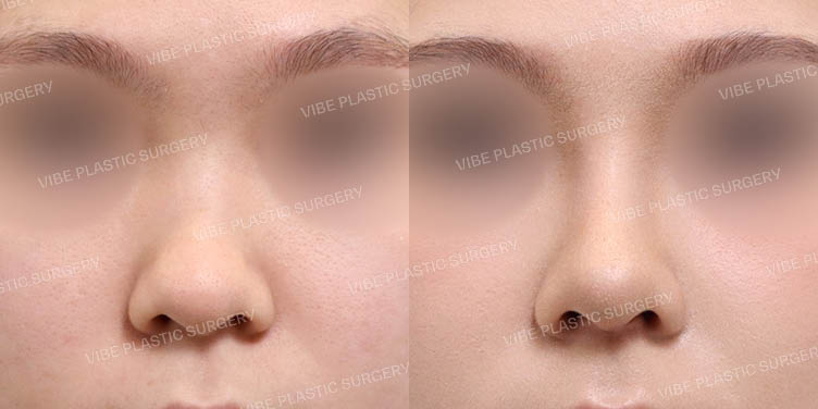 #복코 #짧은코 #콧대