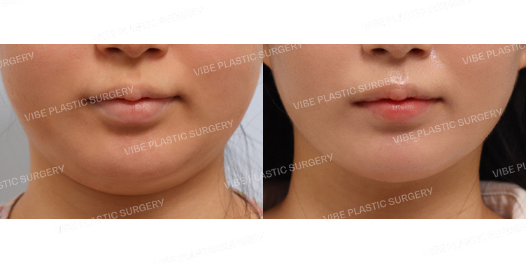 #초음파지방흡입(이중턱,턱라인)