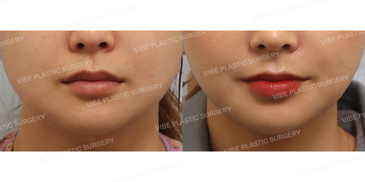 #초음파지방흡입(이중턱,턱라인) #심부볼지방제거