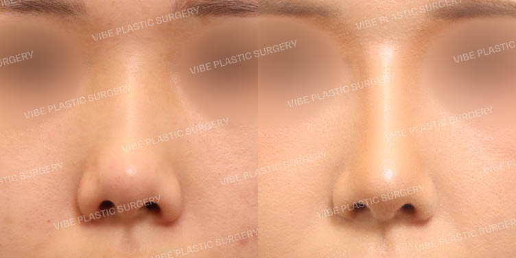 #낮은코 #짧은코 #매부리코