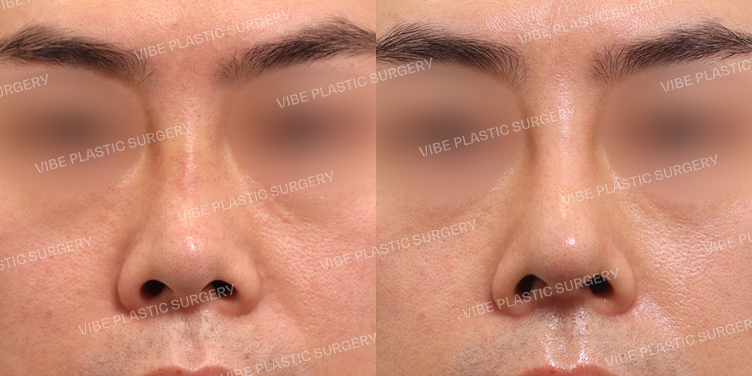 #짧은코 #콧볼축소 #기능코