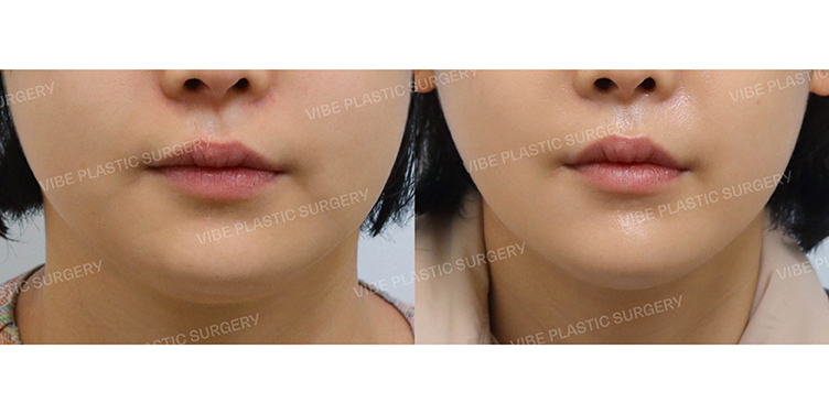 #초음파지방흡입(이중턱,턱라인) #심부볼지방제거 #슈링크