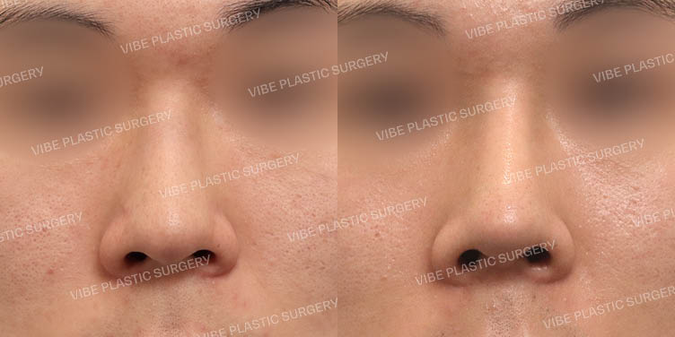 #남자코 #낮은코 #매부리코