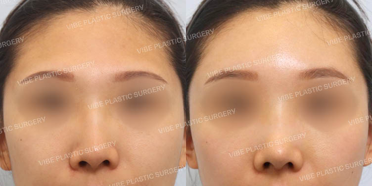 #내시경이마거상 #이마지방이식 #매부리코 #긴코 #넓은코 #무보형물