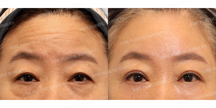 #내시경이마거상 #상안검 #하안검