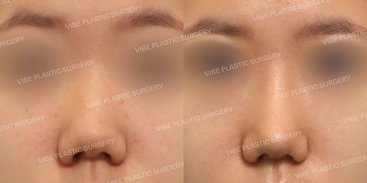 #복코 #비주교정