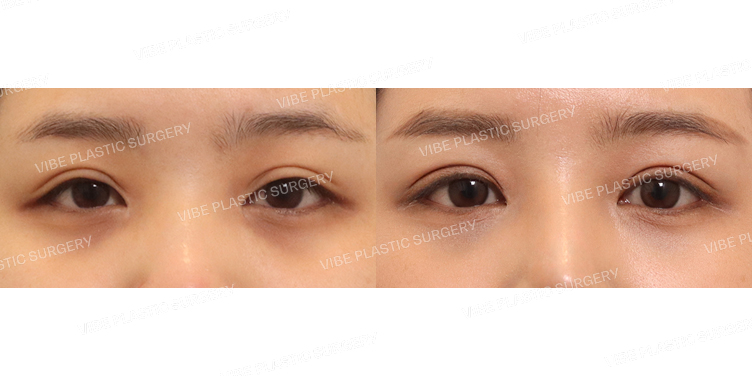 #절개눈매교정(재수술)