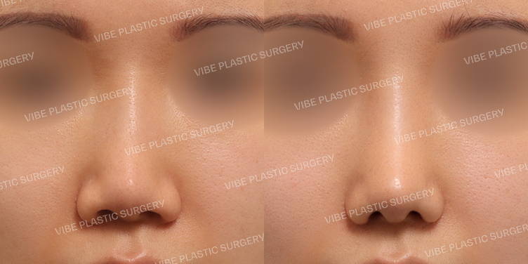 #낮은코 #휜코(재수술)