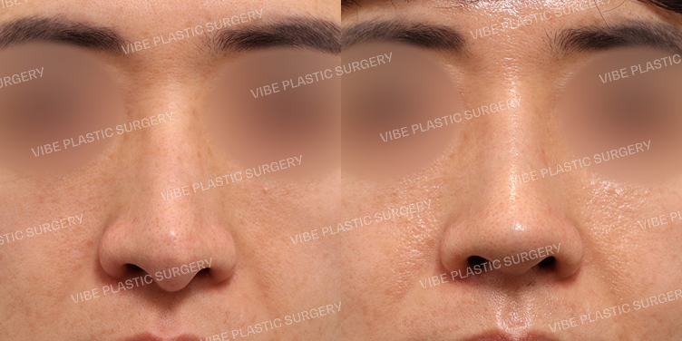 #남자코(재수술) #비주교정 #휜코 #기능코