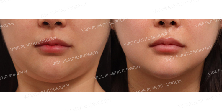 #초음파지방흡입(이중턱,턱라인)