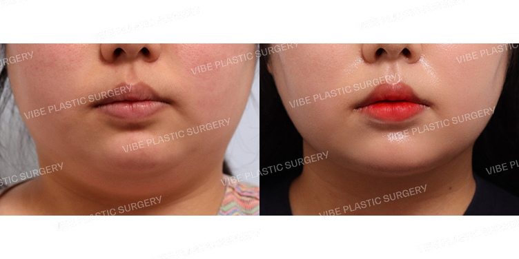 #초음파지방흡입(이중턱)