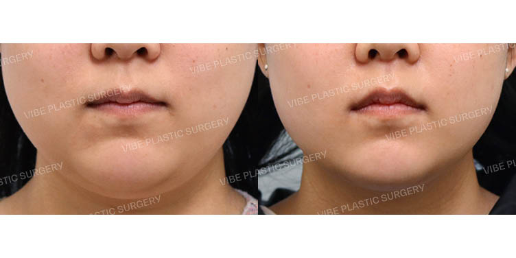 #초음파지방흡입(이중턱,턱라인)