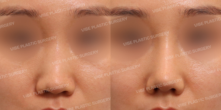 #낮은코 #매부리코 #긴코 #비순각교정