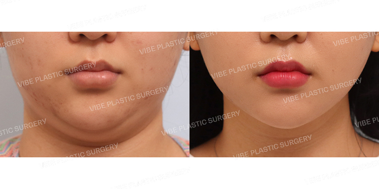 #초음파지방흡입(이중턱,턱라인)