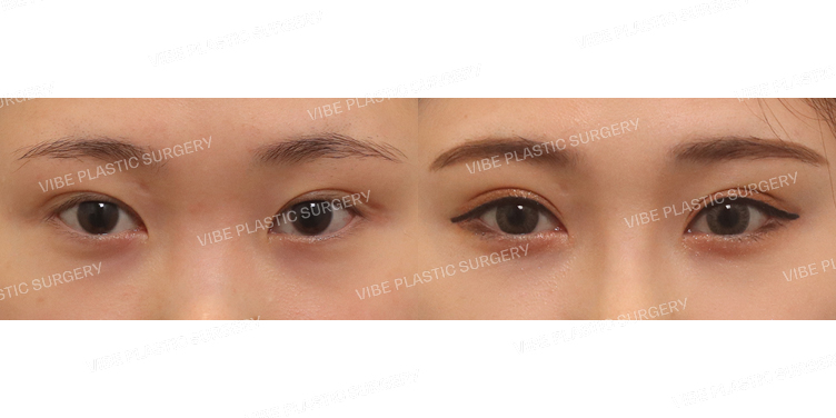 #절개쌍꺼풀(재수술)