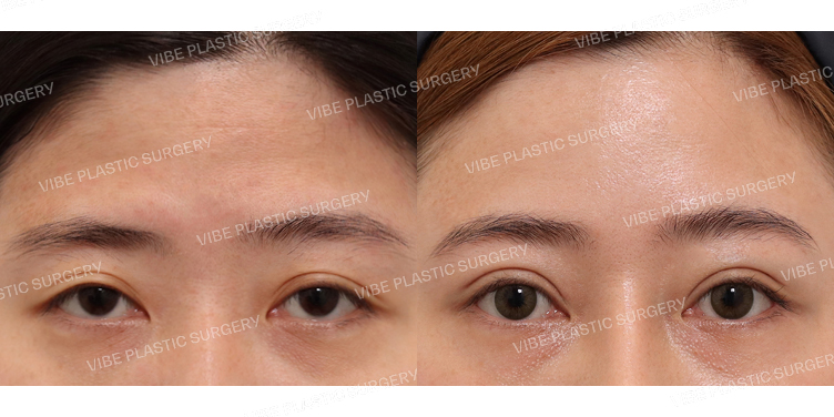 #내시경이마거상 #부분절개눈매교정